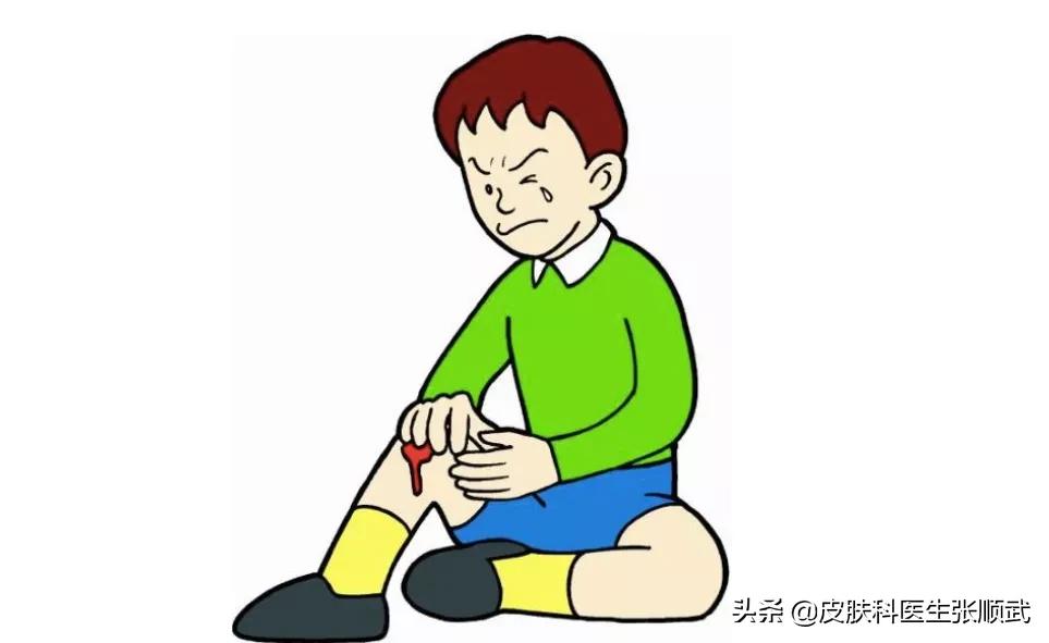 得了银屑病用什么药膏才能好,得了银屑病要预防什么