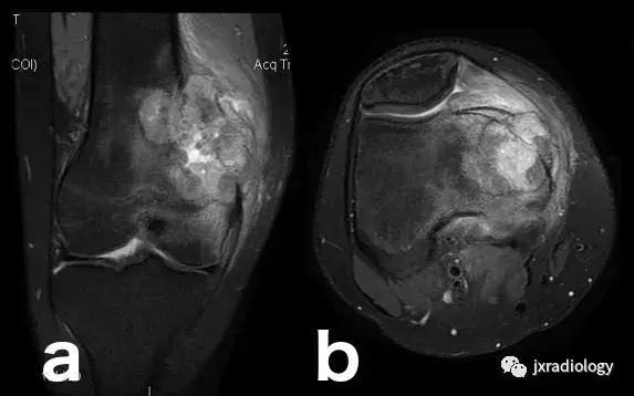 磁共振天天诊断骨髓水肿，但您知道原因吗？