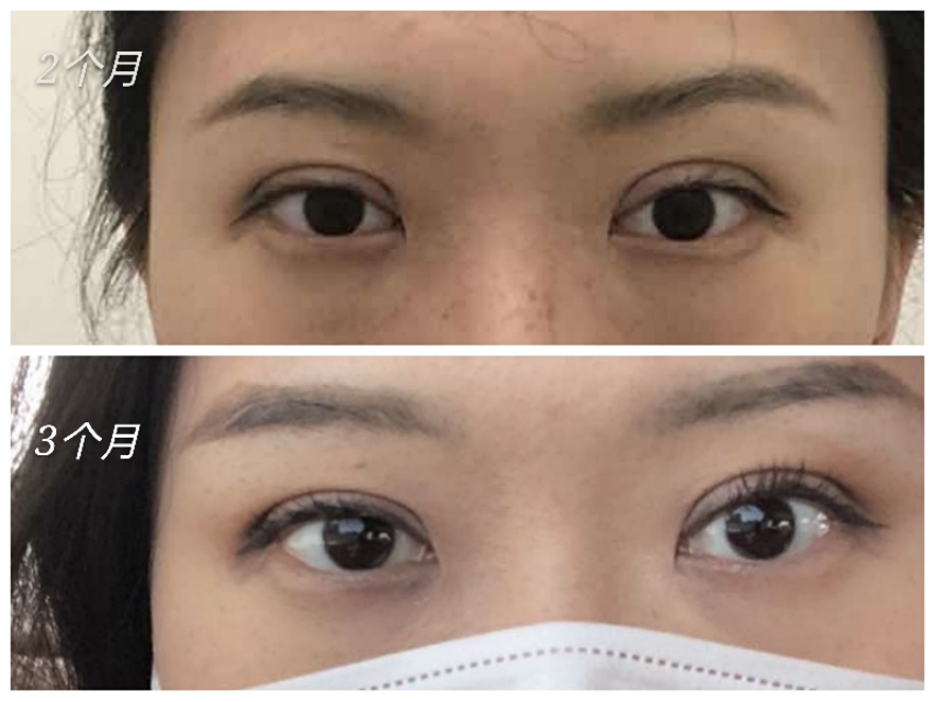 双眼皮前宽后窄算失败吗,双眼皮手术宽度是指恢复后吗