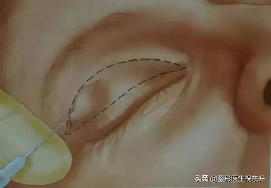 切开法双眼皮,切开双眼皮修复后多久可以再修