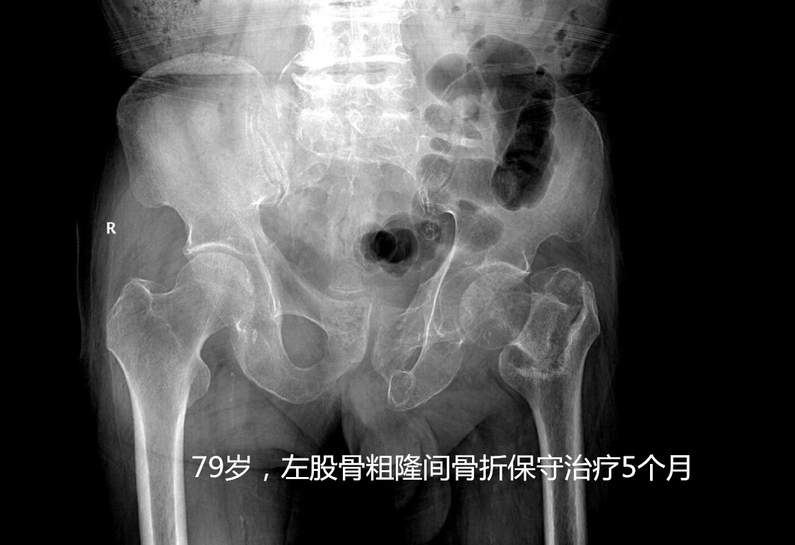 人生最后一次骨折怎么处理,老年髋部骨折是人生最后一次骨折