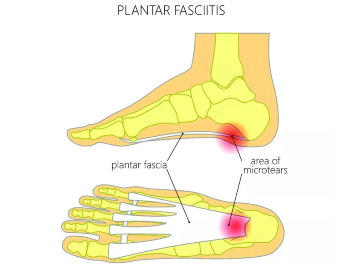 跑者的心酸与无奈,跑步跑的脚痛是怎么回事