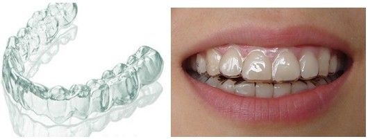 隐形牙套的效果和钢牙效果一样吗,传统牙套和隐形牙套哪个效果好