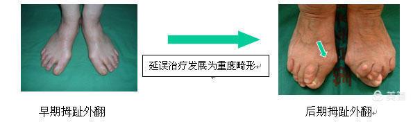 太原中心医院汾东院区骨科,太原汾东中心医院骨科拇外翻大夫