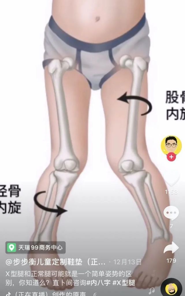 孩子走路“内八”or“外八”，可能和这3个小习惯有关