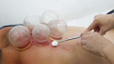 一看就会手把手教拔罐疗法,学拔罐视频教程全集