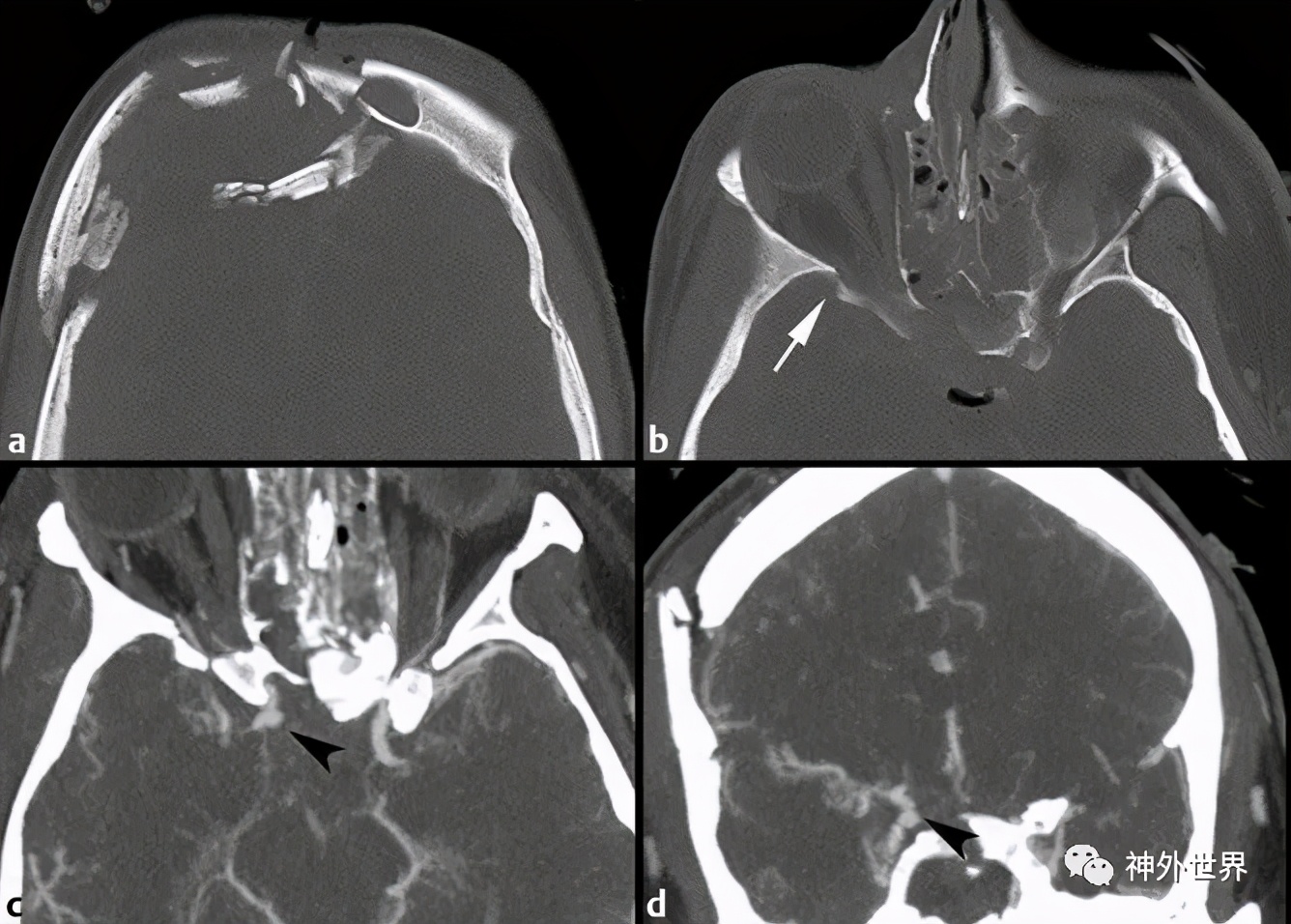 颅底骨折合并脑脊液漏伤情鉴定,颅底骨折伴脑脊液漏右眼眶骨折