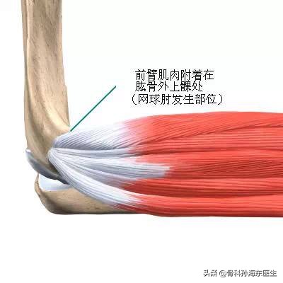 什么是网球肘症状,什么是网球肘怎么治
