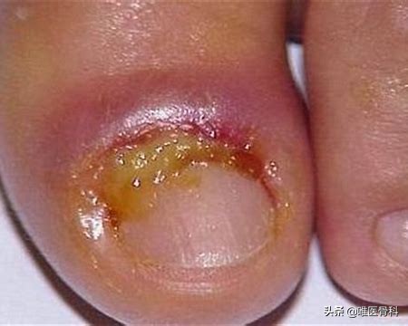 治甲沟炎三招断根,足疗店治甲沟炎一次大概多少钱