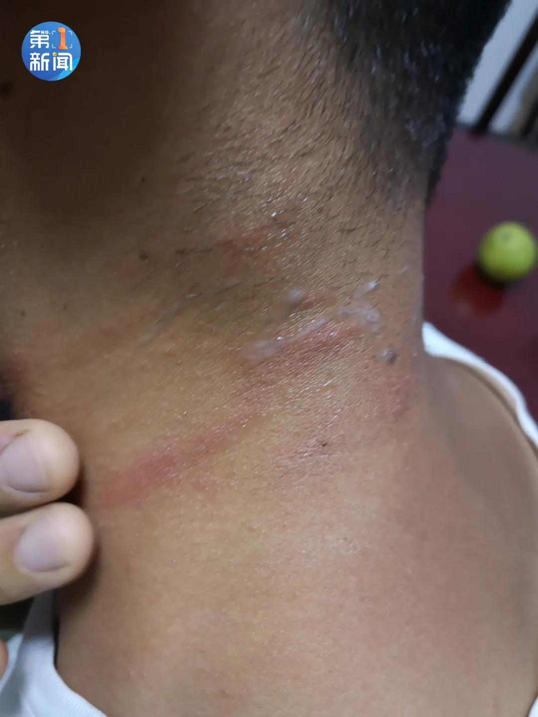 男孩户外拍死一只虫子,小伙拍死一只虫子后果不堪设想