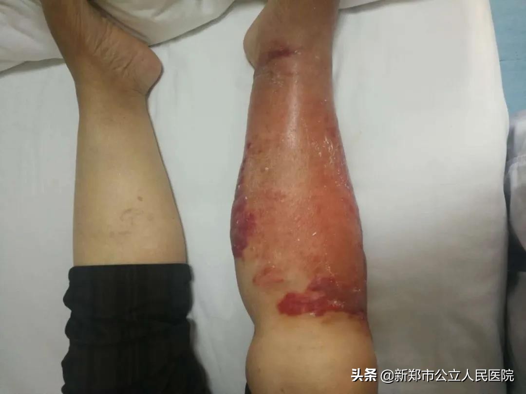 小腿又红又肿又痛还烫,小腿又红又肿