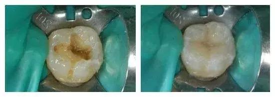 牙齿烂了一半为什么不能补牙,牙齿缺了一半补牙要多少钱