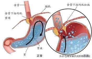 从昨天到现在一直打嗝是什么原因,请问大夫老是打嗝怎么办