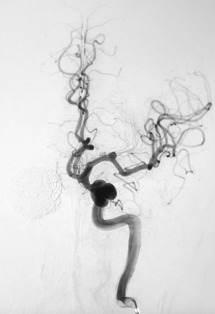 国外怎么治疗动脉瘤,全世界颅内动脉瘤最佳的治疗