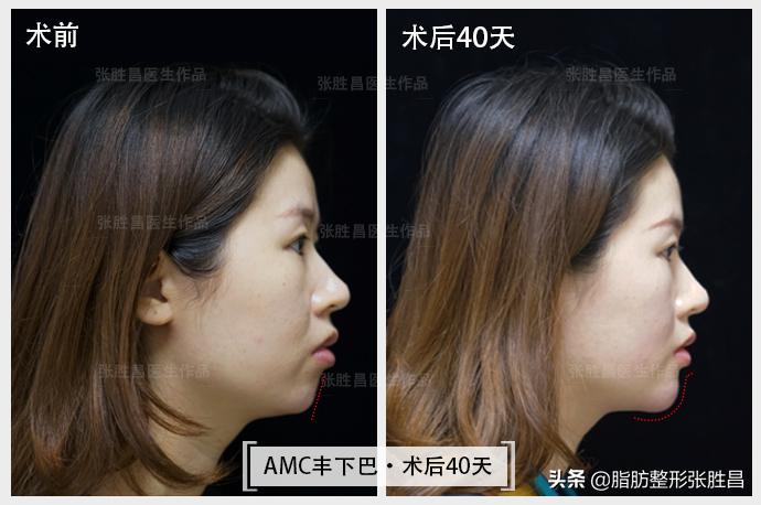 后缩的下巴打玻尿酸效果会好吗,下巴后缩打玻尿酸有效果吗