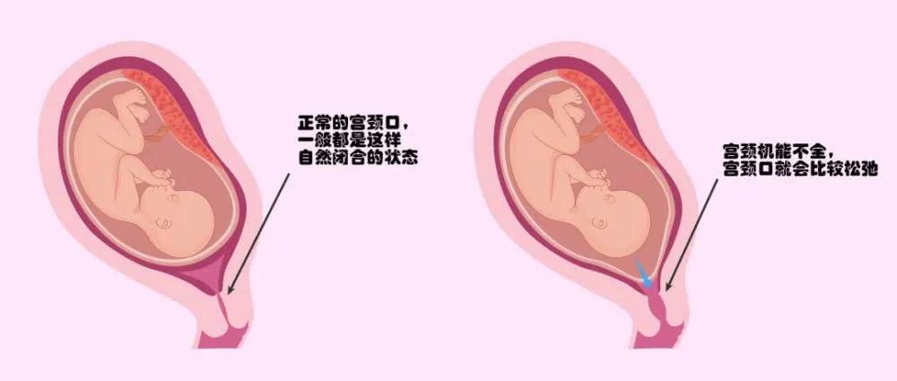 试管双胞胎一胎胎停会流血吗,试管双胞胎有一个胎停了