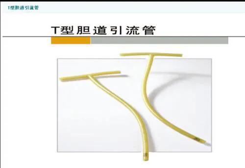 胆道术后t管堵塞的处理,胆道镜术后t管拔管时间