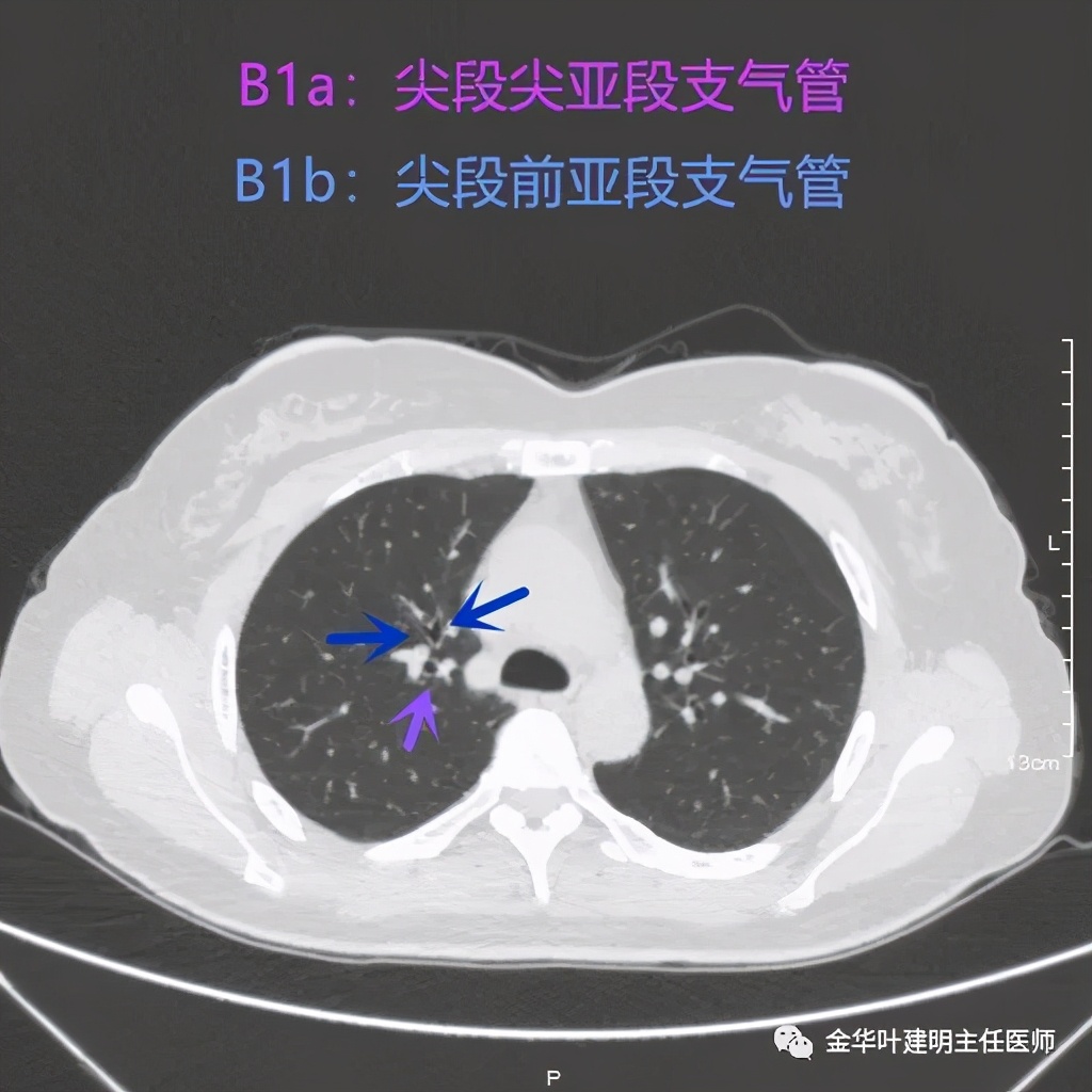 左肺上叶在ct影像上怎么看,平扫ct可以看出肺肿瘤的变化吗