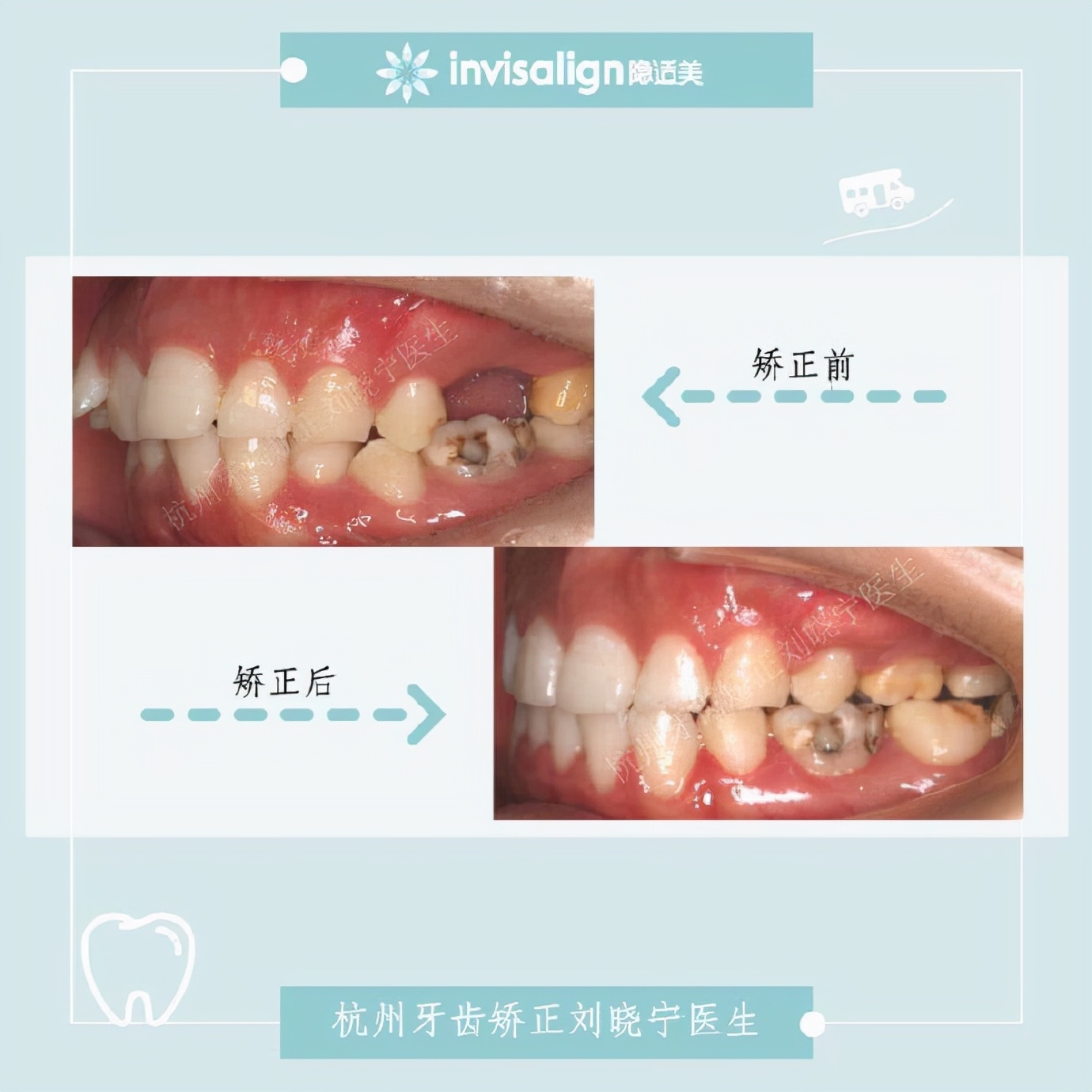 杭州牙齿矫正丨露龈笑怎么办?全面告别露龈笑的4大方法