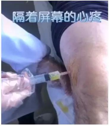 隔着屏幕的心疼！医生抽出民警膝盖里的积液，都已经化脓了