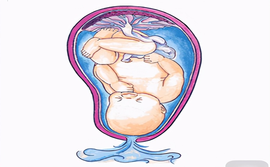 孕妇破水怎么办最有效的方法,孕妇破水了如何处理