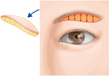上眼皮松弛的适合做全切手术么,上眼皮松弛去皮了更会显老吗