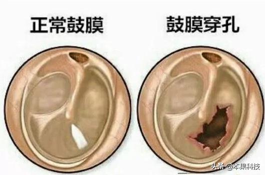 怎么判断孩子耳朵鼓膜是否破了,耳朵里的鼓膜破了
