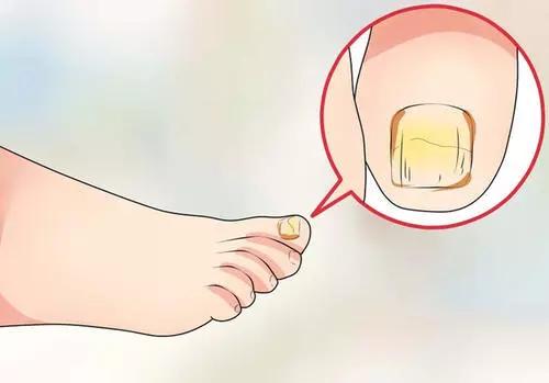 灰指甲治好后指甲变厚还是灰甲吗,灰指甲治好了指甲怎么还是厚的