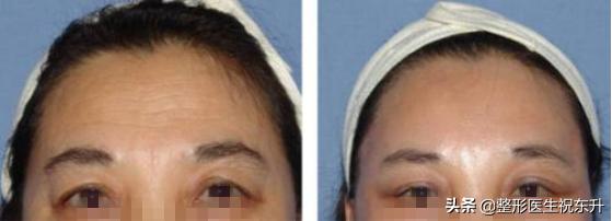 额部除皱术的目的是什么,什么是额部除皱术