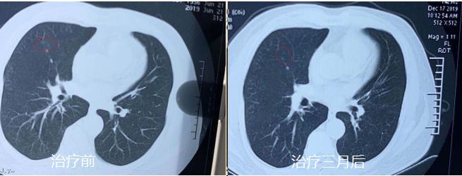 双肺多发微小结节最大的5mm严重吗,双肺多发微结节3-4mm用吃药治疗吗