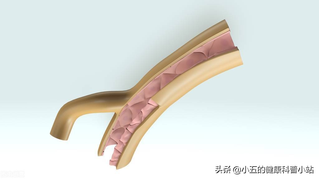 能稳定斑块的中成药,既能降压又能降脂的药