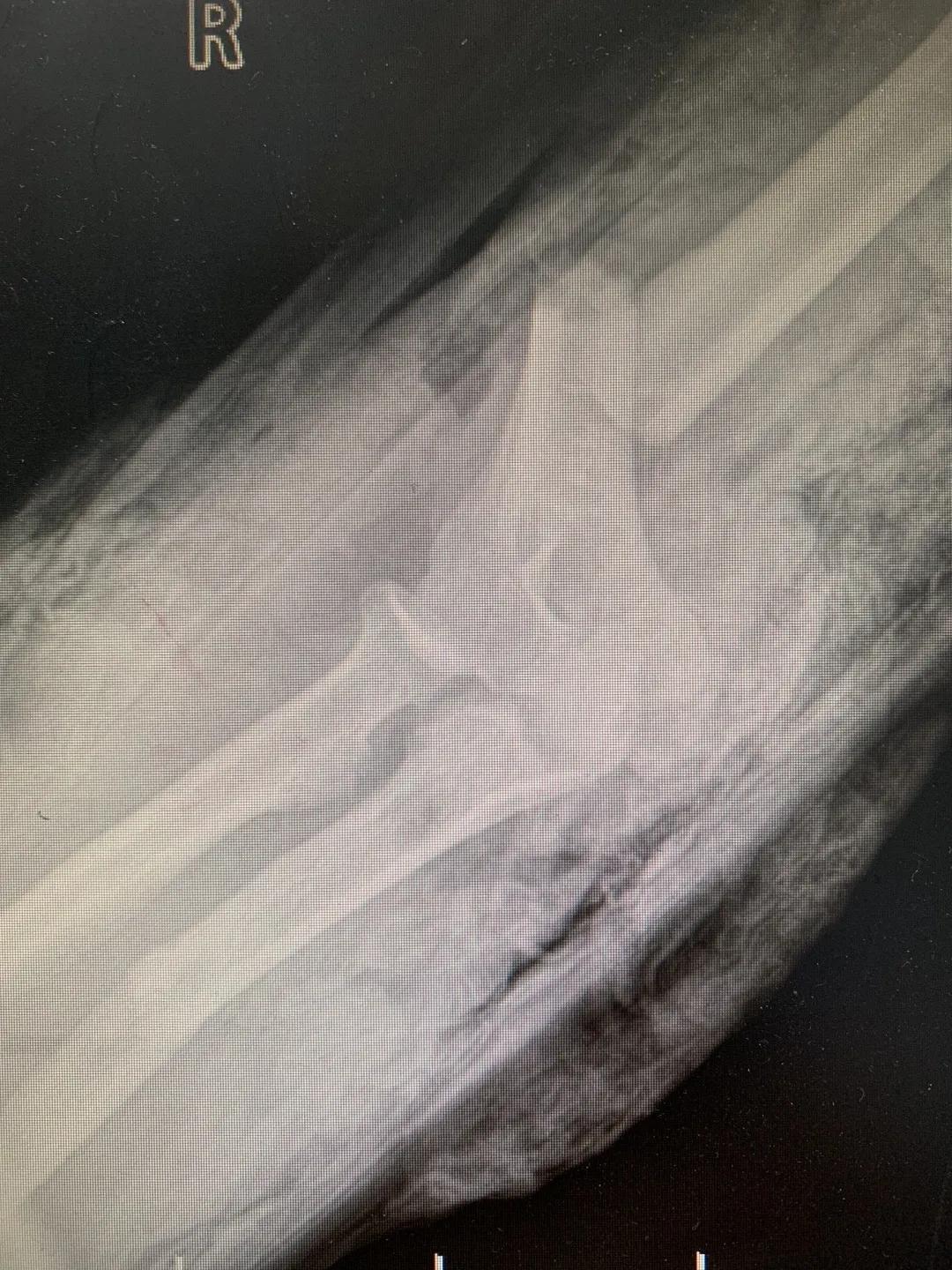 【日照市人民医院】右臂卷入机器被撕裂 6.5小时成功复活