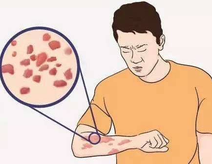 痒疹是如何引起的,引起痒疹的原因