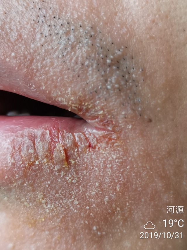 冬季多发口角炎(烂嘴角),中医怎么治?