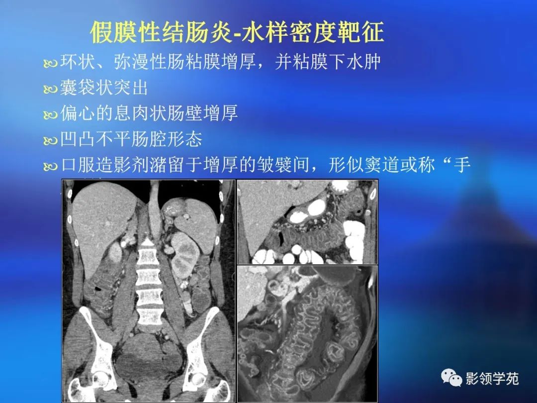 肠道内壁增厚,肠道扩张ct表现
