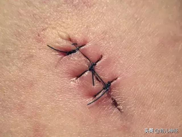 顺产撕裂与侧切有什么区别,顺产撕裂和侧切的区别是什么