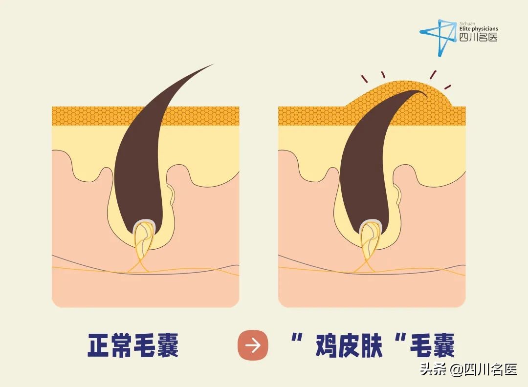 鸡皮肤太丑怎么办啊,鸡皮肤太丑怎么处理好看