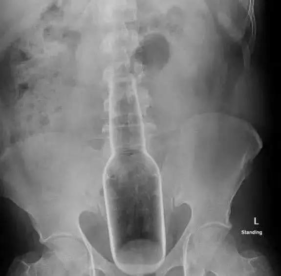 神操作！东莞阿叔将18cm长玻璃瓶塞进肛门...