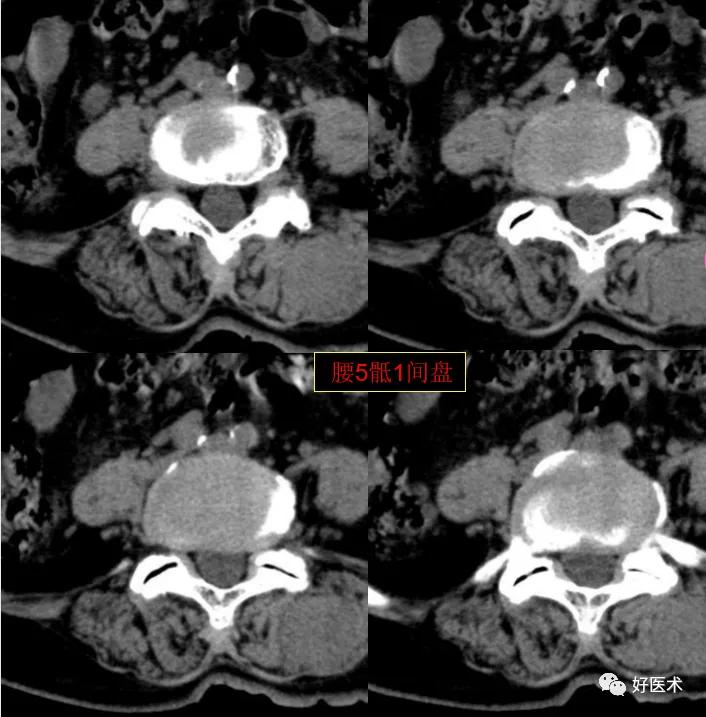 腰部ct需要注意事项,做腰部ct需要注意的事项