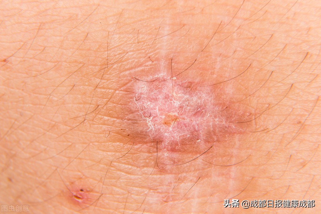 如何抚平烧伤疤痕,怎么去除厚厚的烧伤疤痕增生