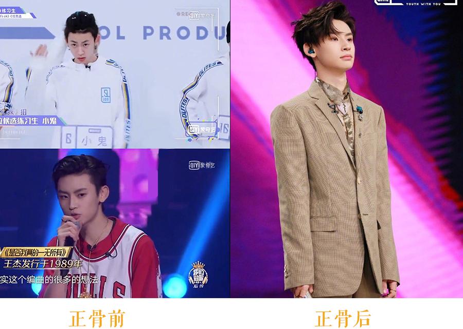 明星正骨后遗症,明星正骨效果明显