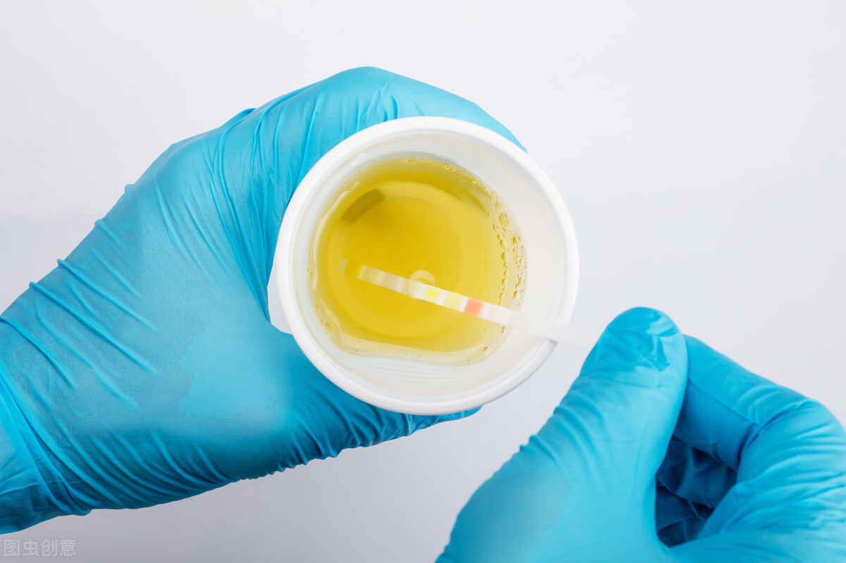 尿常规大部分人都做错了,想要准确的检测结果就要选择这样留尿