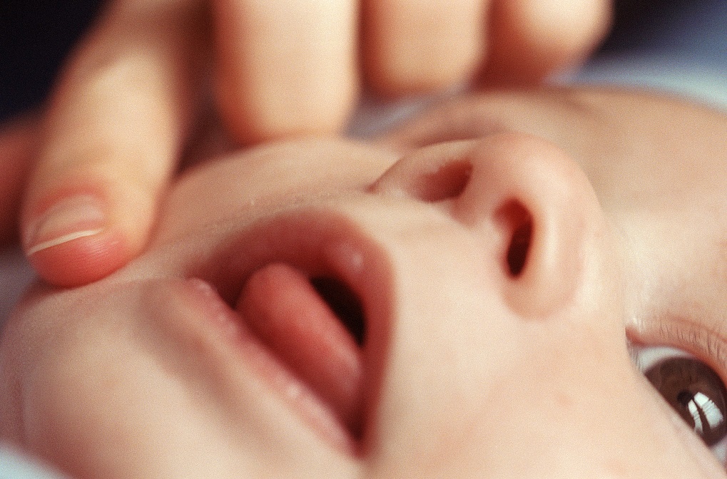 鹅口疮婴儿涂药实操,宝宝鹅口疮片