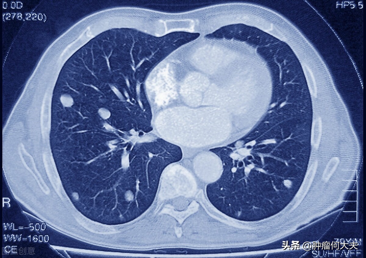 癌症种类和复发率,癌症转移的几种方式