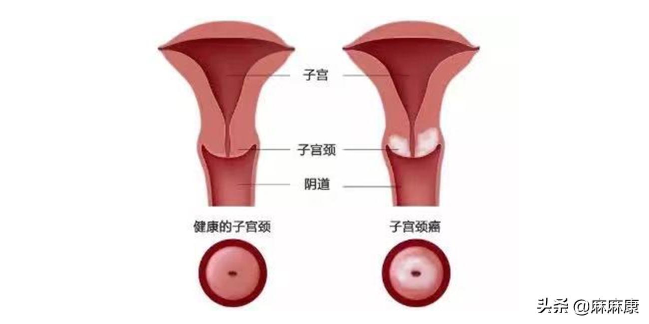 宫颈癌是什么原因引起的?这4种预防手段,很多人都遗漏了