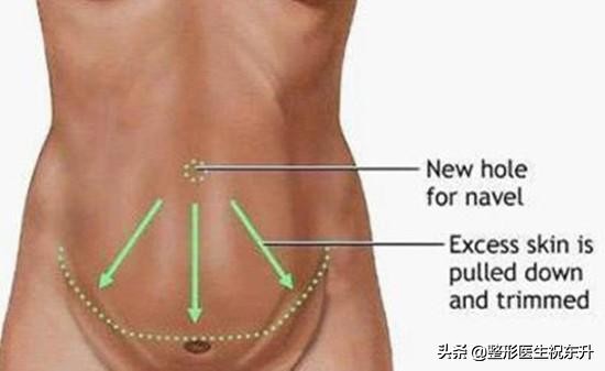 腹部腹壁整形,腹壁整形恢复后腹部图片