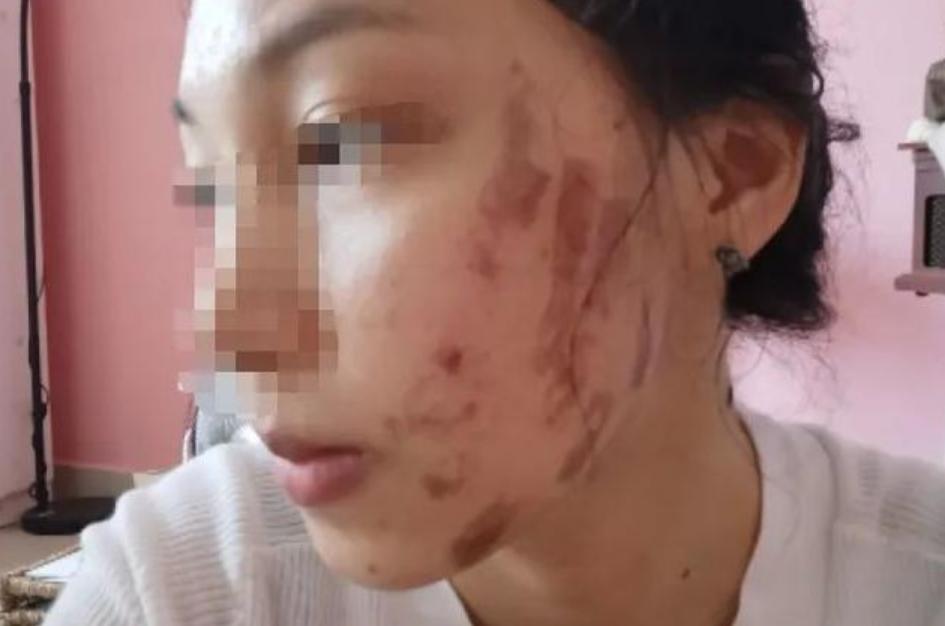 光子嫩肤打完起泡留疤了怎么修复,姑娘做完光子嫩肤后脸上全是黑疤