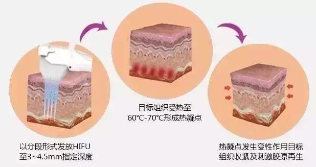 超声刀和热玛吉哪个提升效果好,超声刀和埋线提升哪个效果好