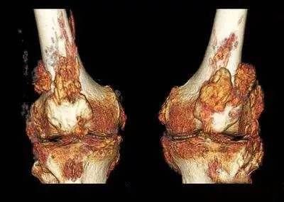 痛风发作期苯溴马隆的正确吃法,急性痛风发作期能吃苯溴马隆吗