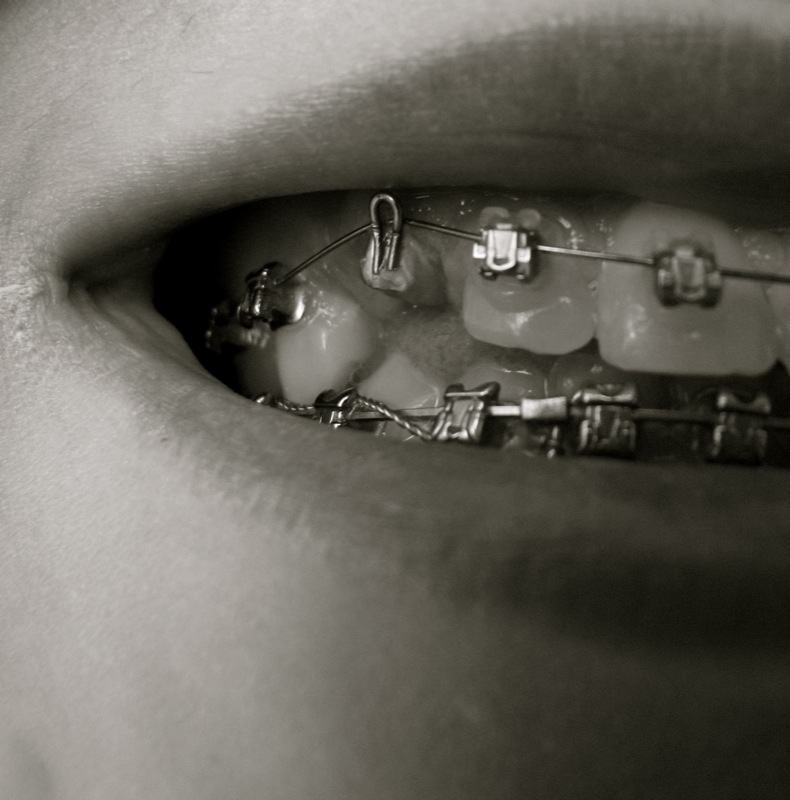 正畸反弹会怎么处理,正畸矫正后却反弹了怎么办